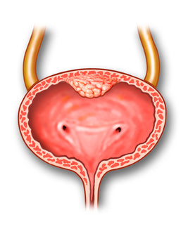bladder_ureteral_cancer-1