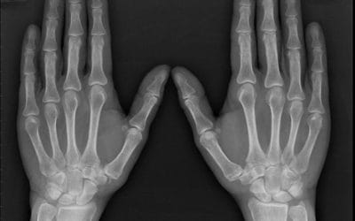 PT in the News: Jane Brody on Arthritis in The New York Times